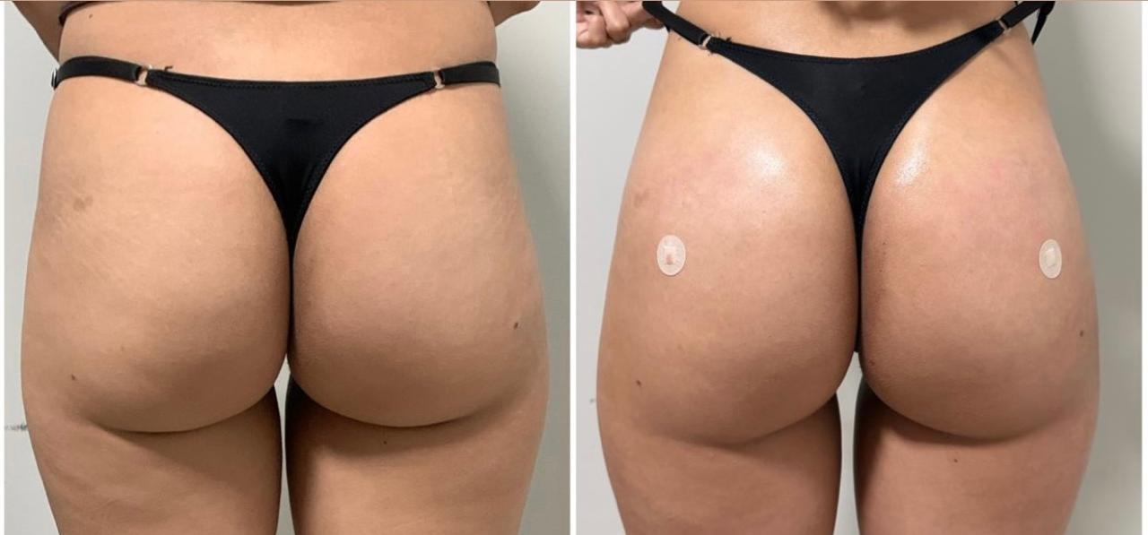 Antes e depois · vista posterior