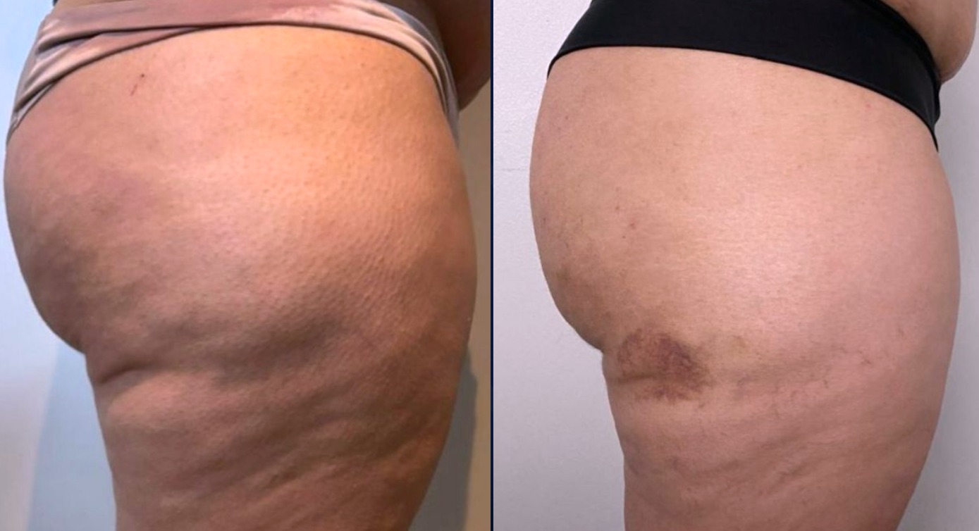 Antes e depois · vista lateral