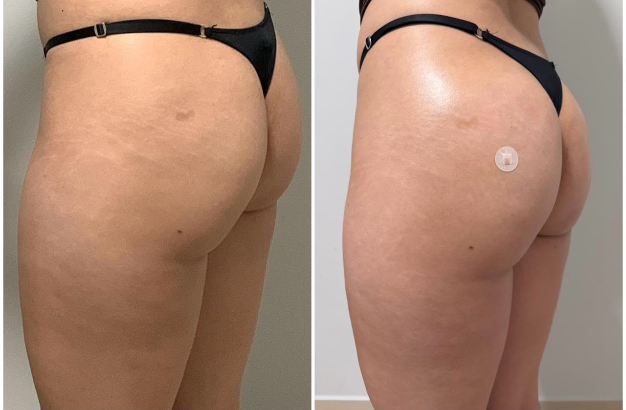 Antes e depois · vista oblíqua